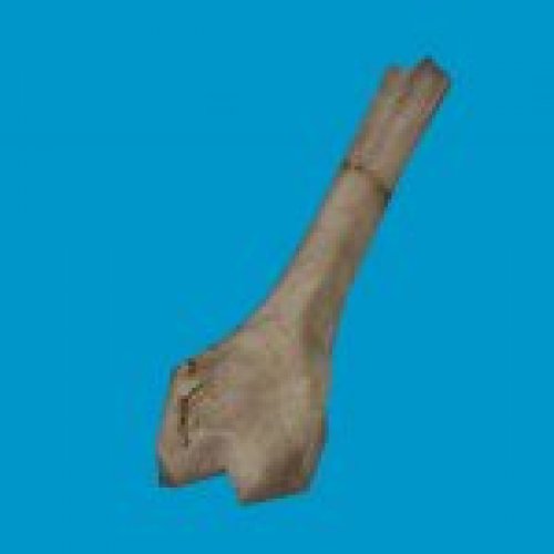 bt femur broken